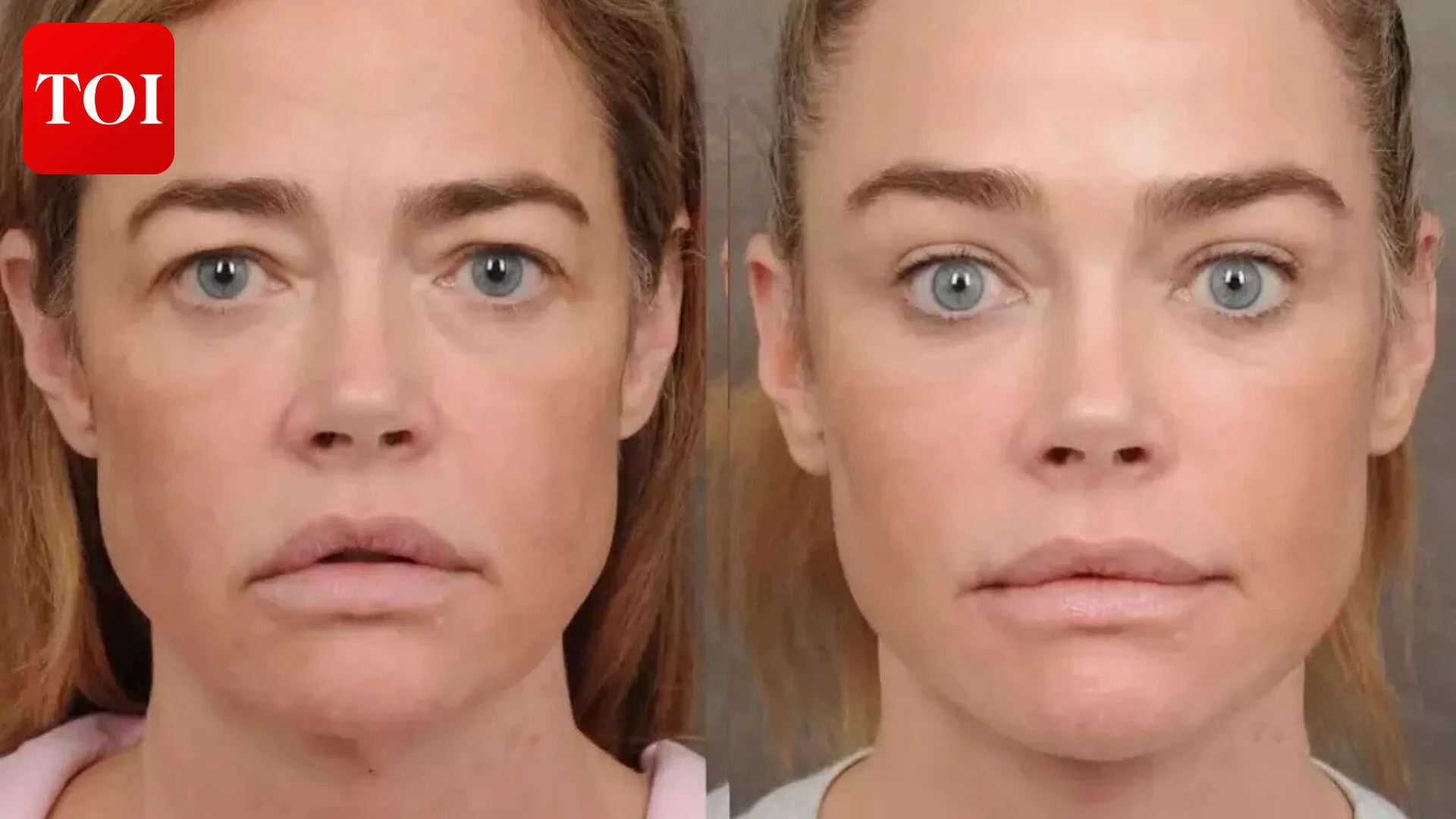 Denise Richards' before and after pics post facelift go VIRAL